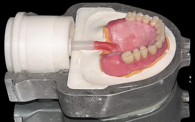 Изготовление съемных протезов на зубы